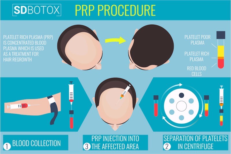 prp plasma hair restoration