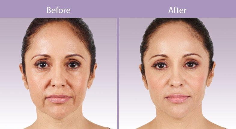 Lip Augmentation Filler